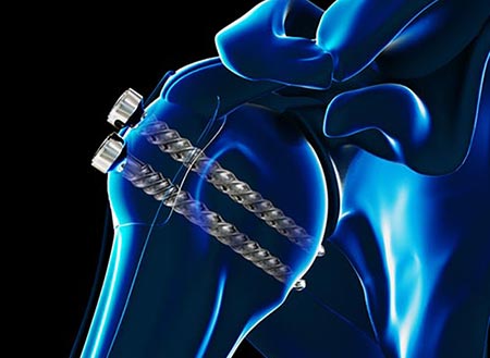 Management of Proximal Humerus Fractures