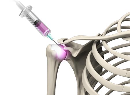 Non-Replacement Treatments for Shoulder Osteoarthritis