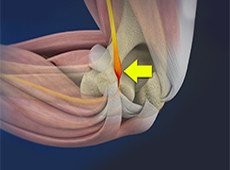 Cubital Tunnel Syndrome