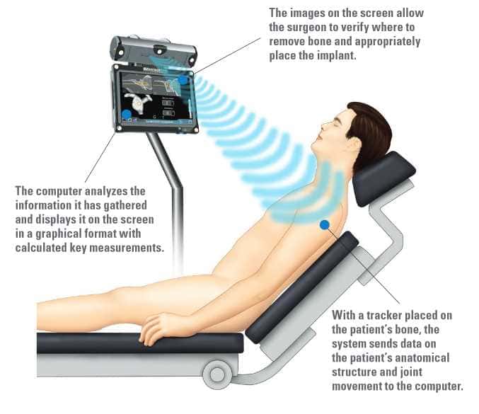 shoulder replacement performed using ExactechGPS