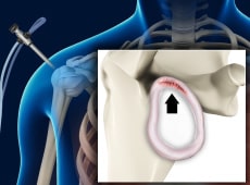 Labral Repair