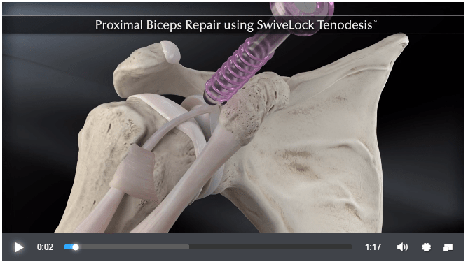 Proximal Biceps Repair using SwiveLock® Tenodesis