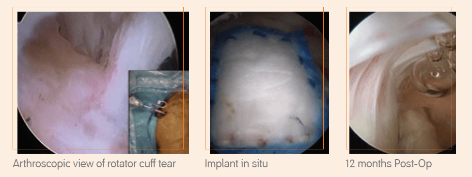 REGENETEN Bioinductive Implant